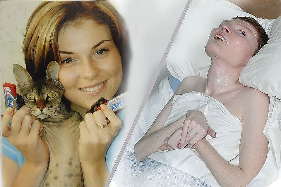 Беда случилась с Ириной Пекарской, когда ей было 22 года. Фото слева сделано незадолго до пожара