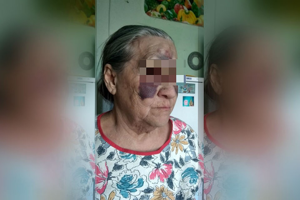 На фотографии лицо женщины покрыто гематомами и кровоподтеками