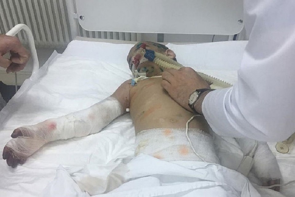 Девочку прооперировали — её рука почти спасена