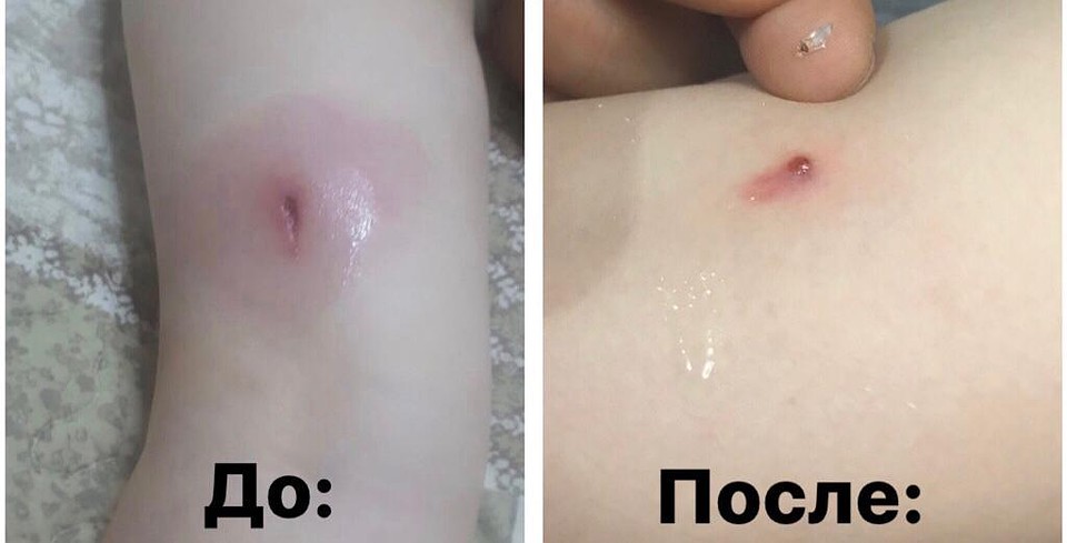Все три месяца девочка жаловалась на боль в ноге