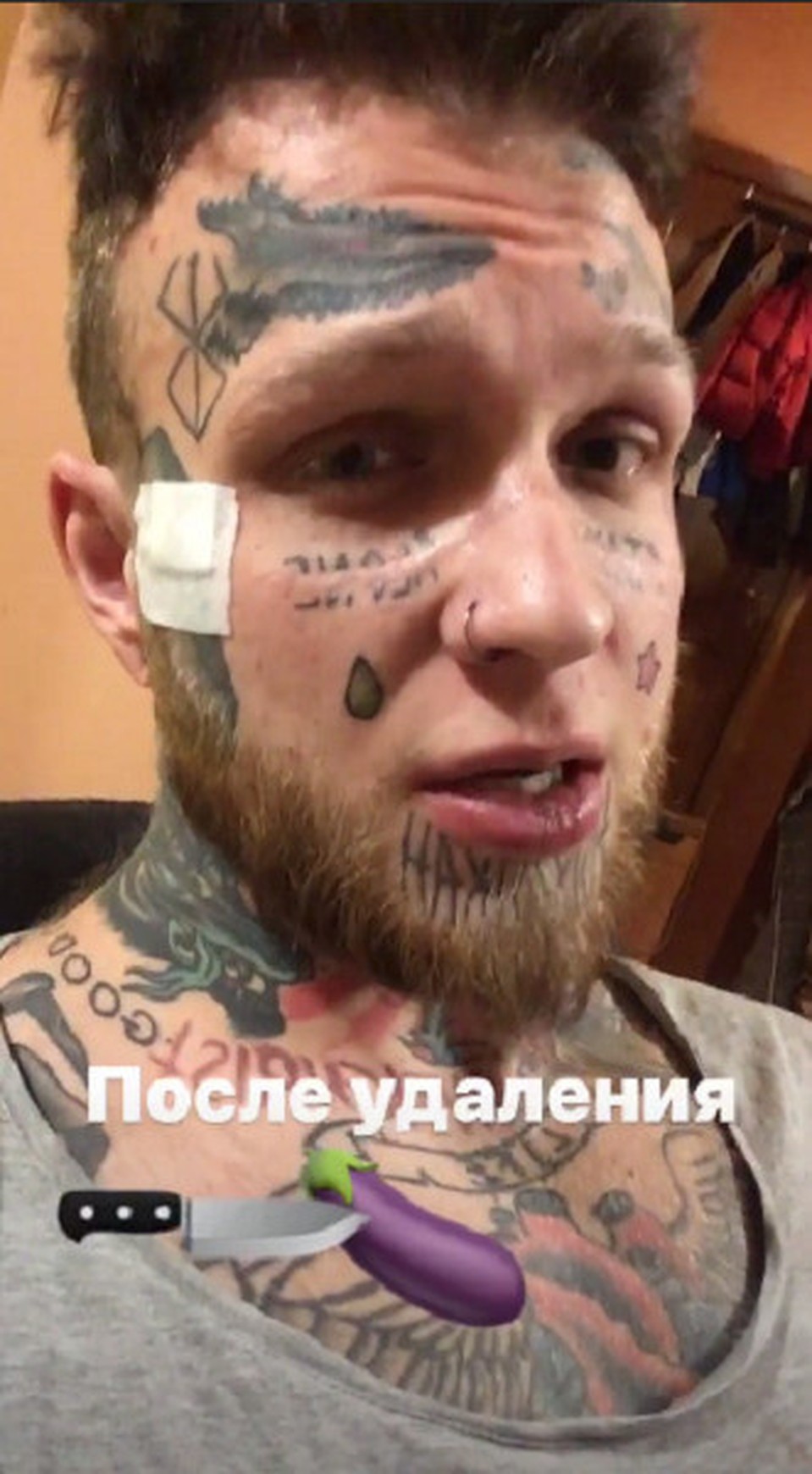 Вероятно, Денис просто поранился - на его щеке наклеен пластырь. Фото: Инстаграм.