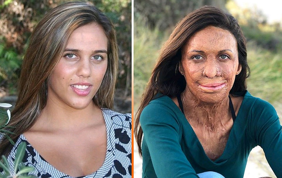 Лесной пожар навсегда изменил внешность и жизнь Турии Питт. Фото: instagram.com/turiapitt