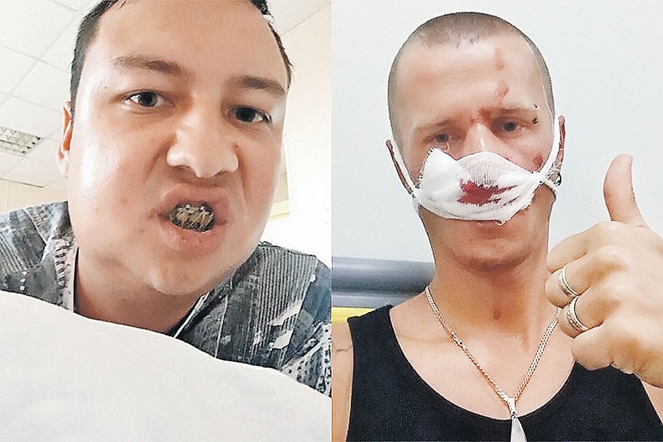 В августе 2018 года банда из 15 ауешников за один вечер избила 16 человек на улицах Санкт-Петербурга. На снимке - двое потерпевших. У одного сломана челюсть, у другого - нос Фото: СОЦСЕТИ