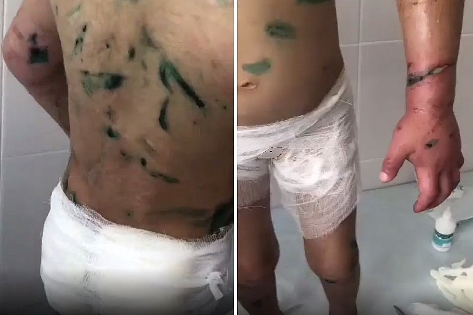 На теле девочки буквально нет живого места. Фото: кадр видео