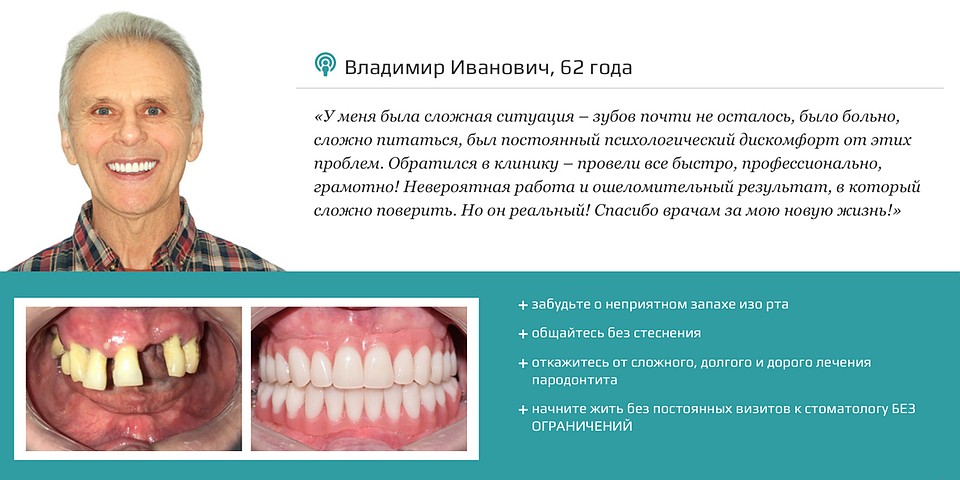 Часто на запущенных стадиях пародонтита наиболее оптимальным решением становится имплантация зубов по протоколу немедленной нагрузки.