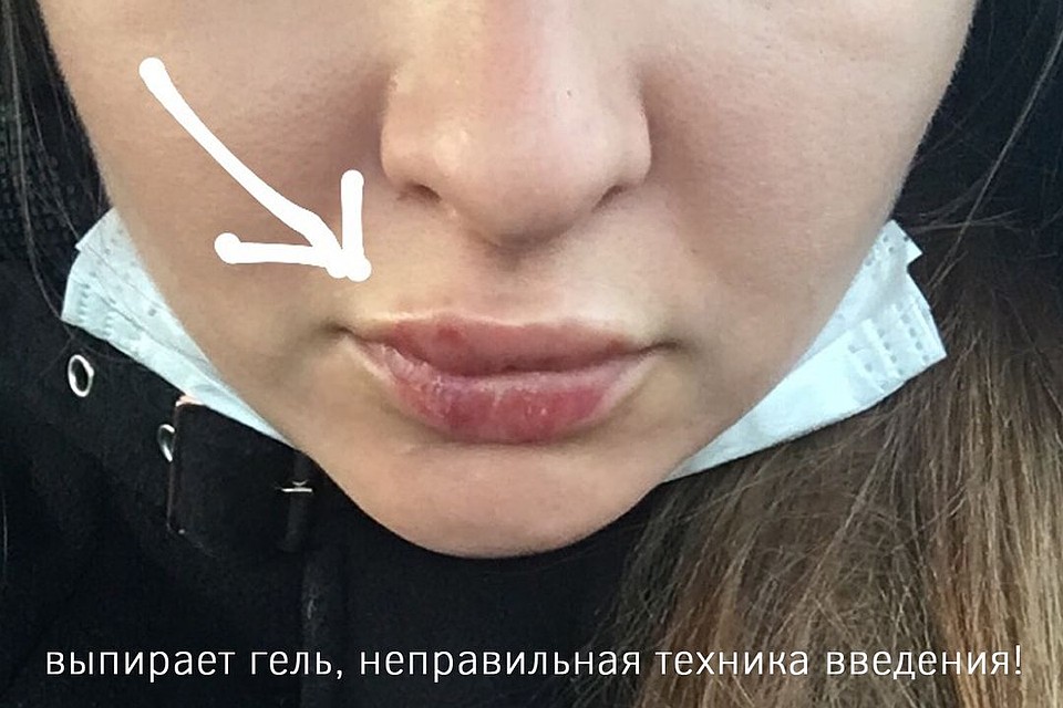 Шишка выскочила буквально через пару дней после увеличения. Фото: личный архив.