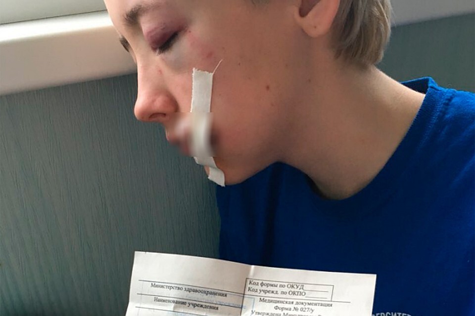 Екатерина рассказала, что на щеку пришлось наложить швы. Фото: СОЦСЕТИ
