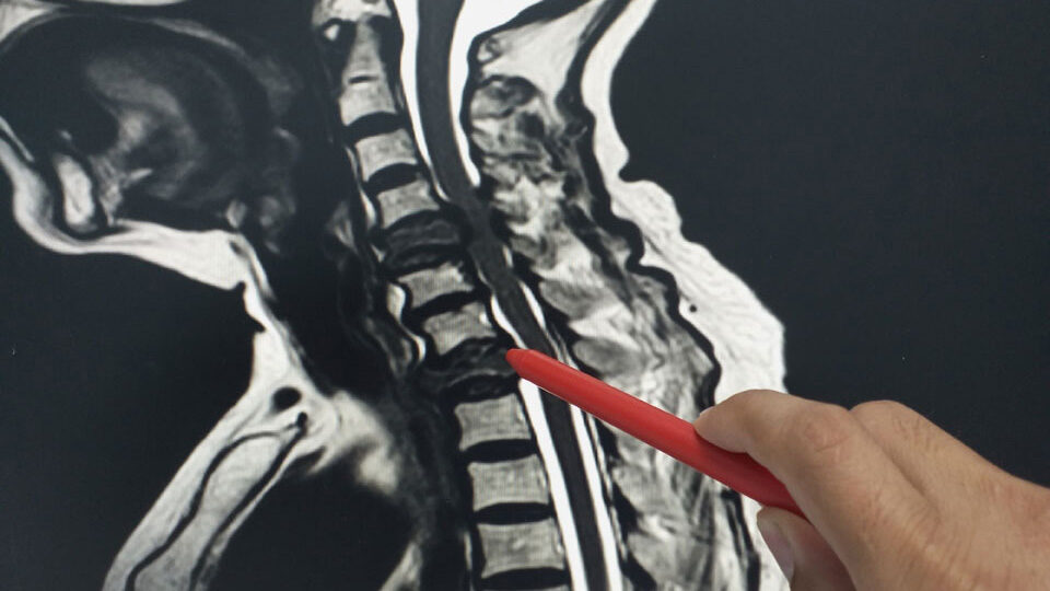 Опухоль спинного мозга у взрослых