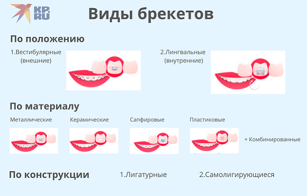 Виды брекетов